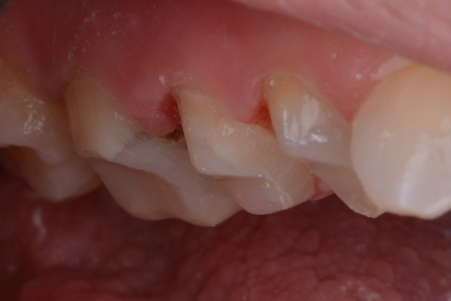 قبل تركيبات اسنان